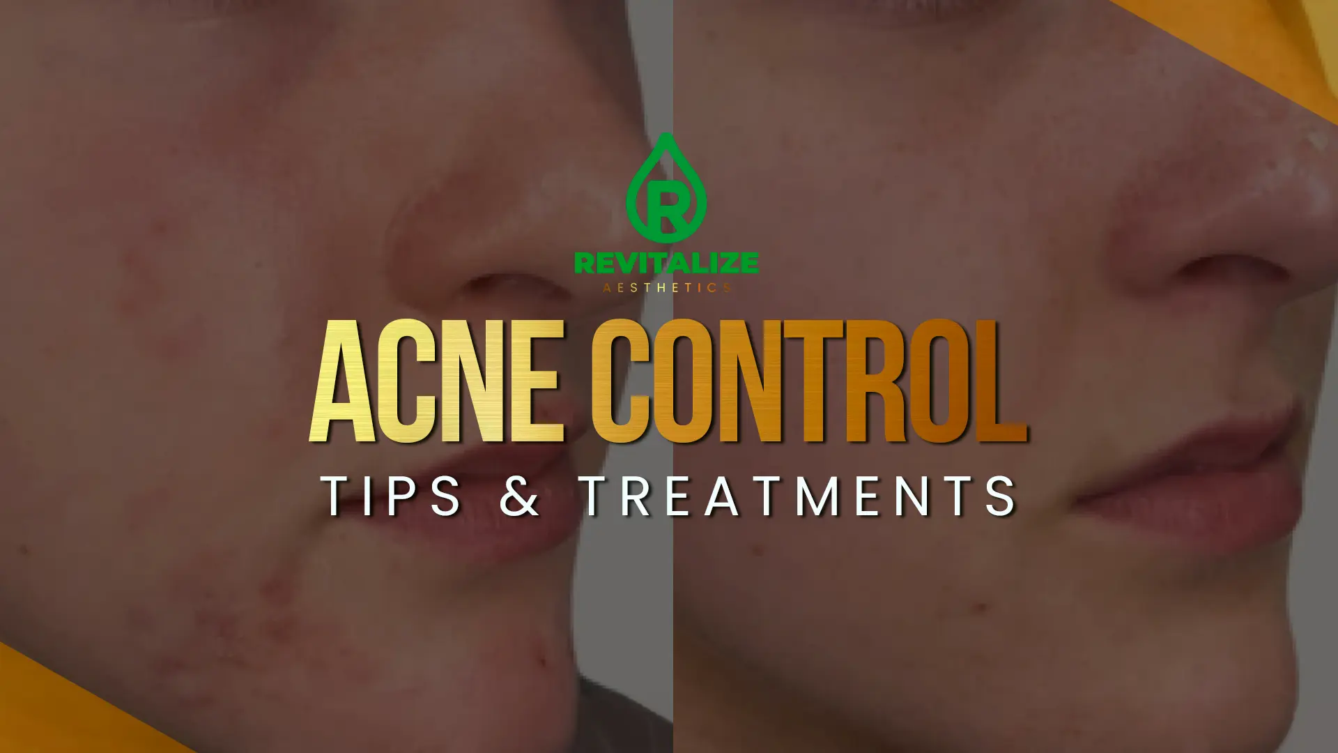 Control Acne